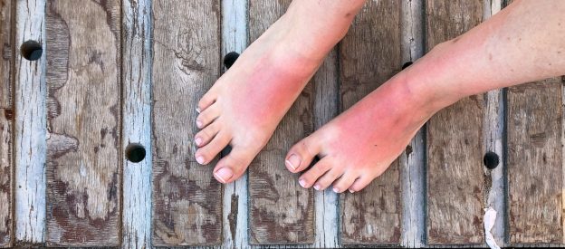 A person displays their sunburned feet